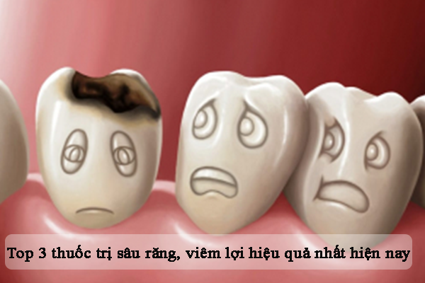 Top 3 thuốc trị sâu răng, viêm lợi tốt nhất hiện nay