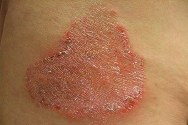 Bệnh hắc lào là gì