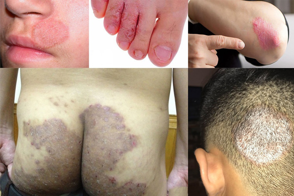 Nguyên nhân gây bệnh hắc lào