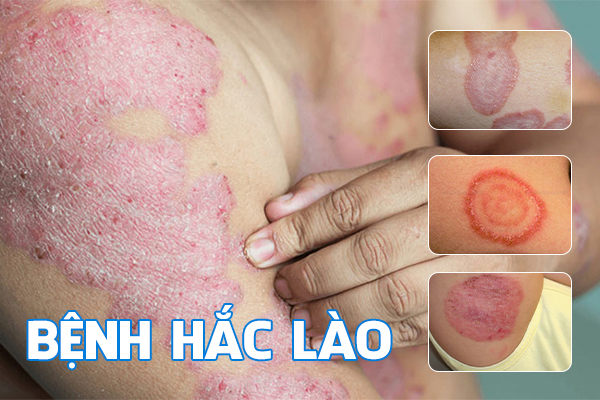 Bệnh hắc lào