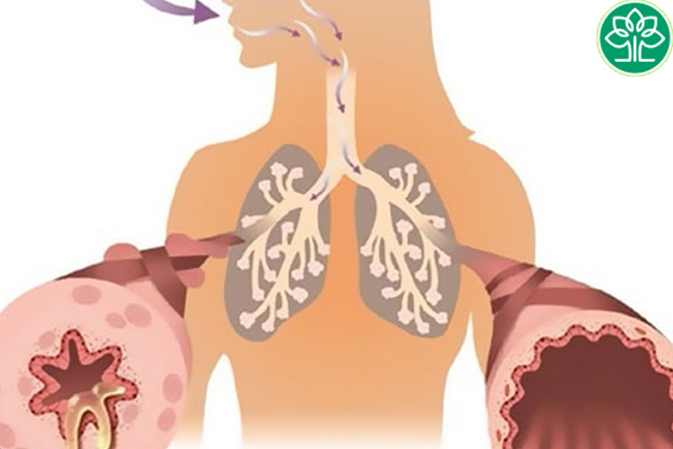 Bệnh hen phế quản bội nhiễm có nguy hiểm không