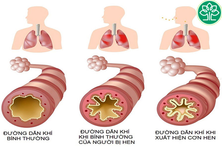 Bệnh hen phế quản mãn tính